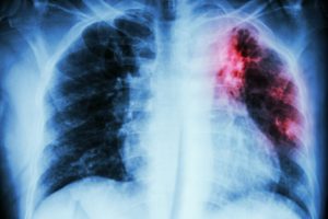 Stock image of x-ray of lungs with tuberculosis